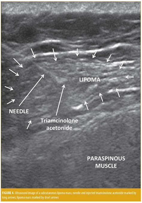 Lipoma Ultrasound Treatment - Infoupdate.org