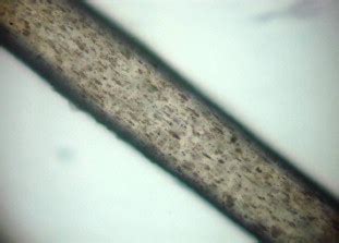 Microscopic examination of the hair shaft shows a typical pattern of ...