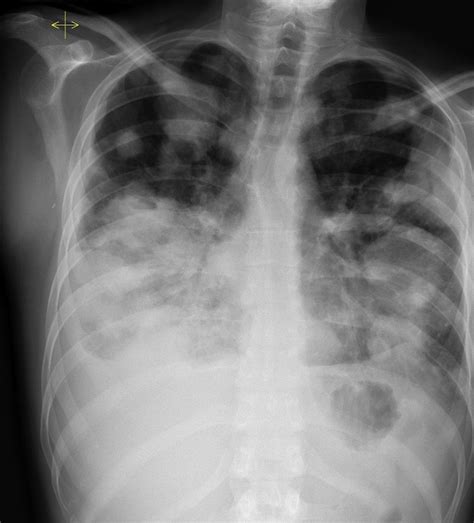 Lung metastases - Radiology at St. Vincent's University Hospital