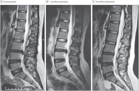 MRI Of Bulging Disc Lower Lumbar