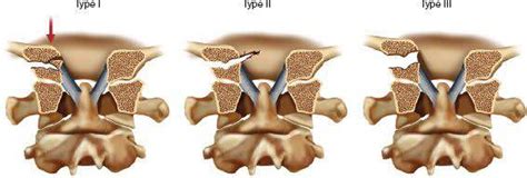 Fractures of the occipital condyle of the skull - Excel Medical Group