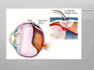 Neovascular glaucoma | PPT