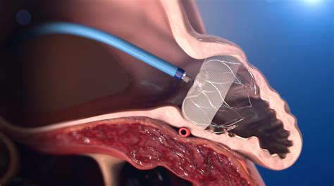 "Watchman" Procedure Reduces Stroke Risk in AFib Patients