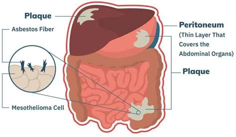 Peritoneal Mesothelioma | Treatment, Prognosis & Diagnosis