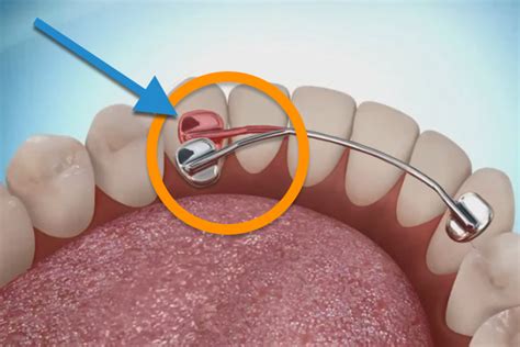 Fixed Orthodontic Retainer