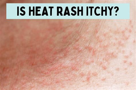 Is Heat Rash Itchy?