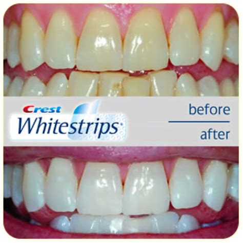 Crest Whitening Strips - Crest 3D White Luxe Professional Effects Teeth ...