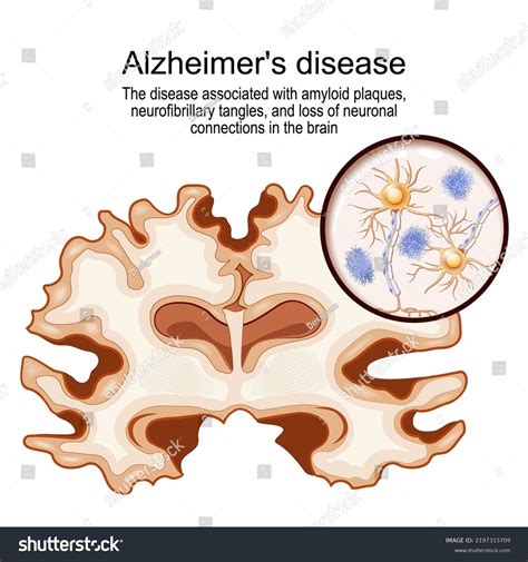 Alzheimers Disease Disease Associated Neurofibrillary Tangles Stock ...