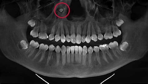 Managing Supernumerary and Ectopic Teeth - Decisions in Dentistry