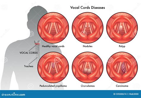 Vocal Cord Diseases Stock Photo - Image: 59500674