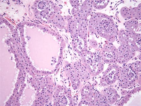 Kidney: Renal Oncocytoma