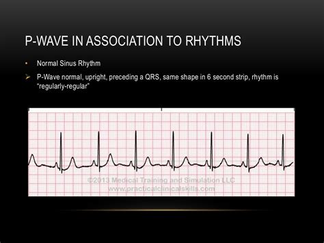 P wave axis and escape rhythms