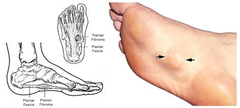 Plantar Fibromas (lumps in the arch of the foot) - Chicago Foot Care Clinic