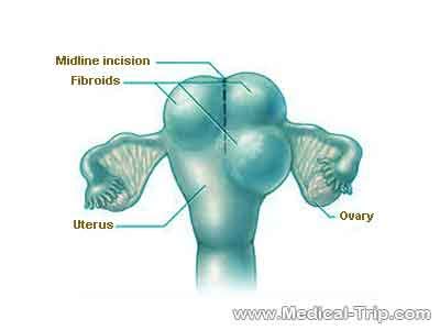 Myomectomy Surgery Expert India | Medical Trip