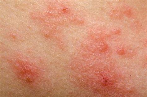 Pictures of Psoriasis (Page 5) | Psoriasis expert