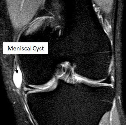 Meniscal Cysts Causes, Presentation and Treatment | Bone and Spine