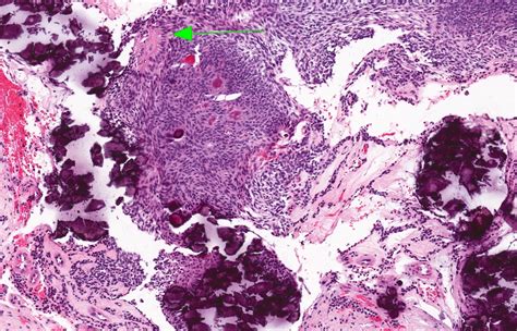 Pathology Outlines - Adenomatoid odontogenic tumor