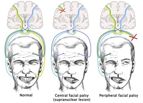 Multiple sclerosis facial paralysis – Telegraph