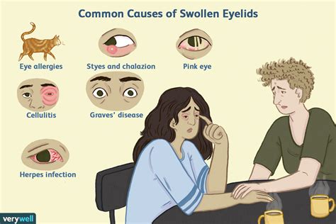 Top Causes of Swollen Eyelids (2023)