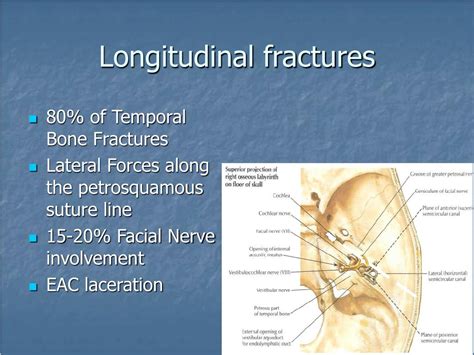 PPT - Fracture of temporal bone PowerPoint Presentation, free download ...