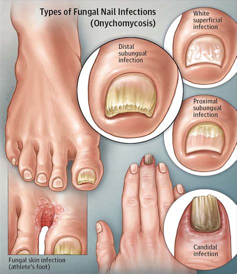 Foot fungus types pictures - Awesome Nail