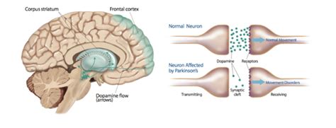 Glossary of Parkinson's disease - Summit for Stem Cell