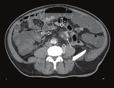 Figure 1. Abdominal CT scan in an axial view after intravenous contrast ...