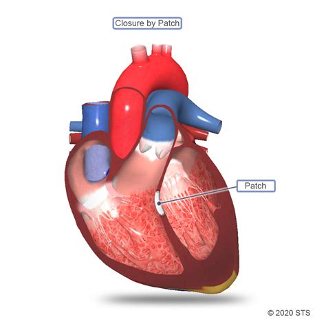 Ventricular Septal Defect Surgery | The Patient Guide to Heart, Lung ...