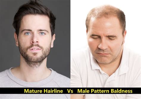 Maturing Hairline Vs. Receding Hairline: What Are The Differences ...