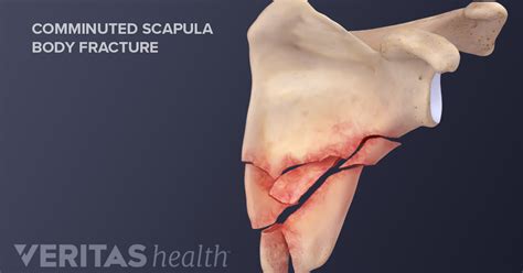 Treating a Scapula Fracture