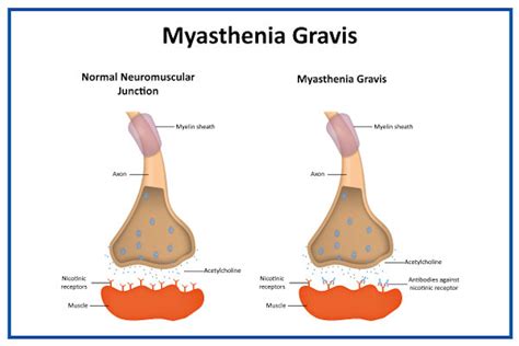 Myasthenia Gravis: Causes, Symptoms & Treatment Options