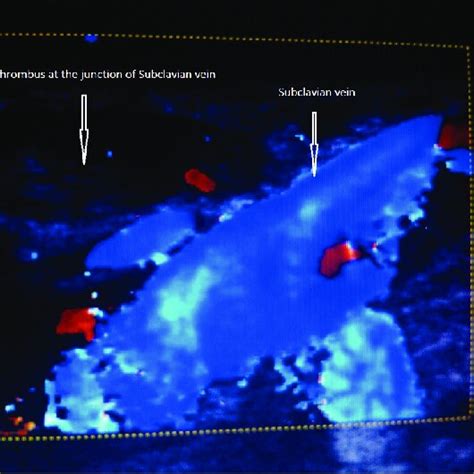 Color Doppler showing internal jugular vein (IJV) thrombosis ...