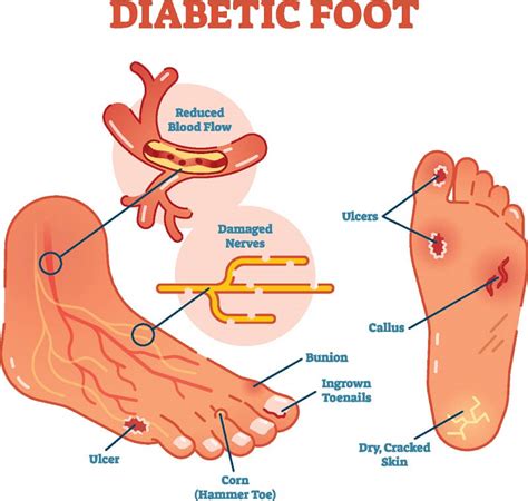 Diabetic Foot | Treatment for Diabetic Neuropathy