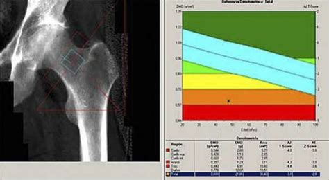 BlogFolio IR Diego Vargas: FUNDAMENTOS DE LA DENSITOMETRIA OSEA ...