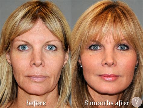 The Y Lift Face Lift Procedure. phoenix skin Y lift before and after Y ...