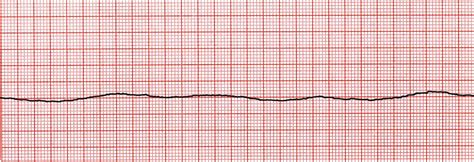 B20: Cardiac Asystole: ECGs at St Emlyn's