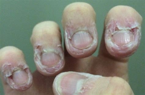 Dermatophagia Biting Skin Around Nails - Madeleine Hemmings