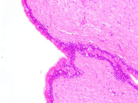 Dentigerous Cyst Histology