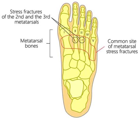 Metatarsal Stress Fractures Brisbane | Brisbane North Clinic