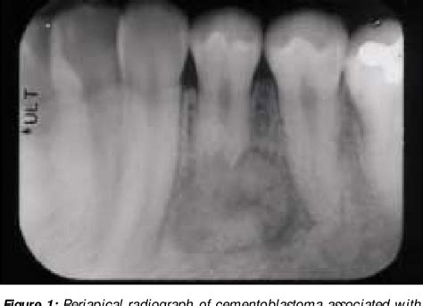 Figure 1 from Benign cementoblastoma: a case report. | Semantic Scholar