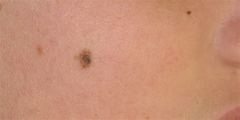 Atypical Melanocytic Lesions | Skin Cancer And Reconstructive Surgery ...