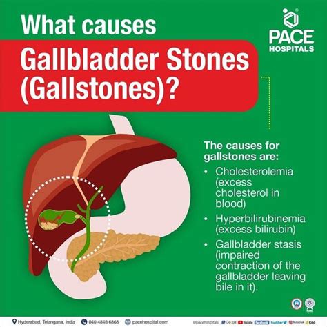 Gallstones, Gallbladder Stones – Symptoms, Causes,, 40% OFF