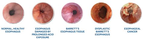 Medtronic – What Is Barrett’s Esophagus | Information and resources ...