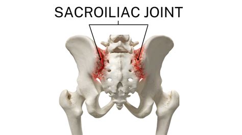 Sacroiliac (SI) Joint Dysfunction - Orthopaedic Spine Surgery Singapore