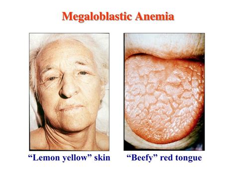 PPT - The Megaloblastic Anemias: Vitamin B 12 & Folate Deficiency ...