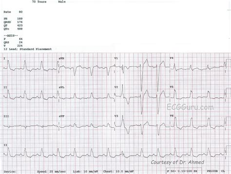 Complete Left Bundle Branch Block