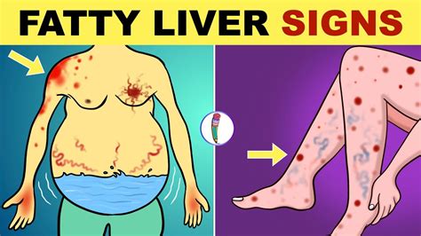 Fatty Liver Disease