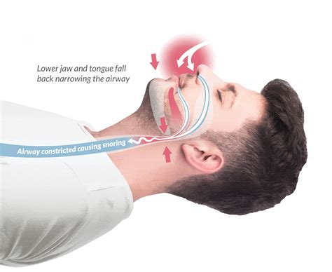 Anti-snoring Mouthpiece - PeekMarket