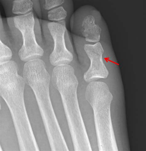 Splinting Proximal Phalanx Fracture