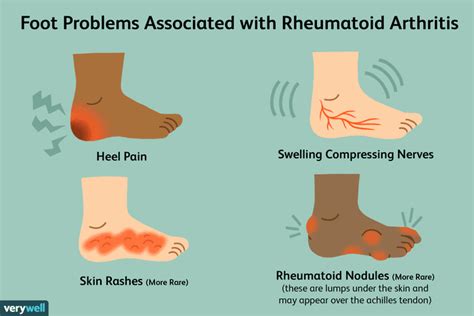 Pain in the Feet As a Symptom of Rheumatoid Arthritis